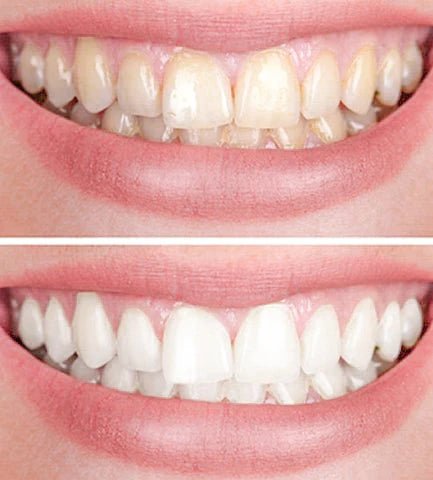 Smiley™ - Zahnaufheller | 1+1 GRATIS