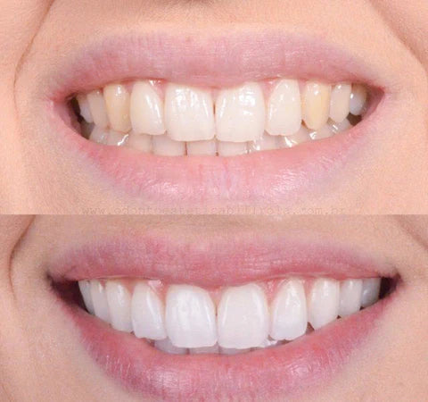 Smiley™ - Zahnaufheller | 1+1 GRATIS