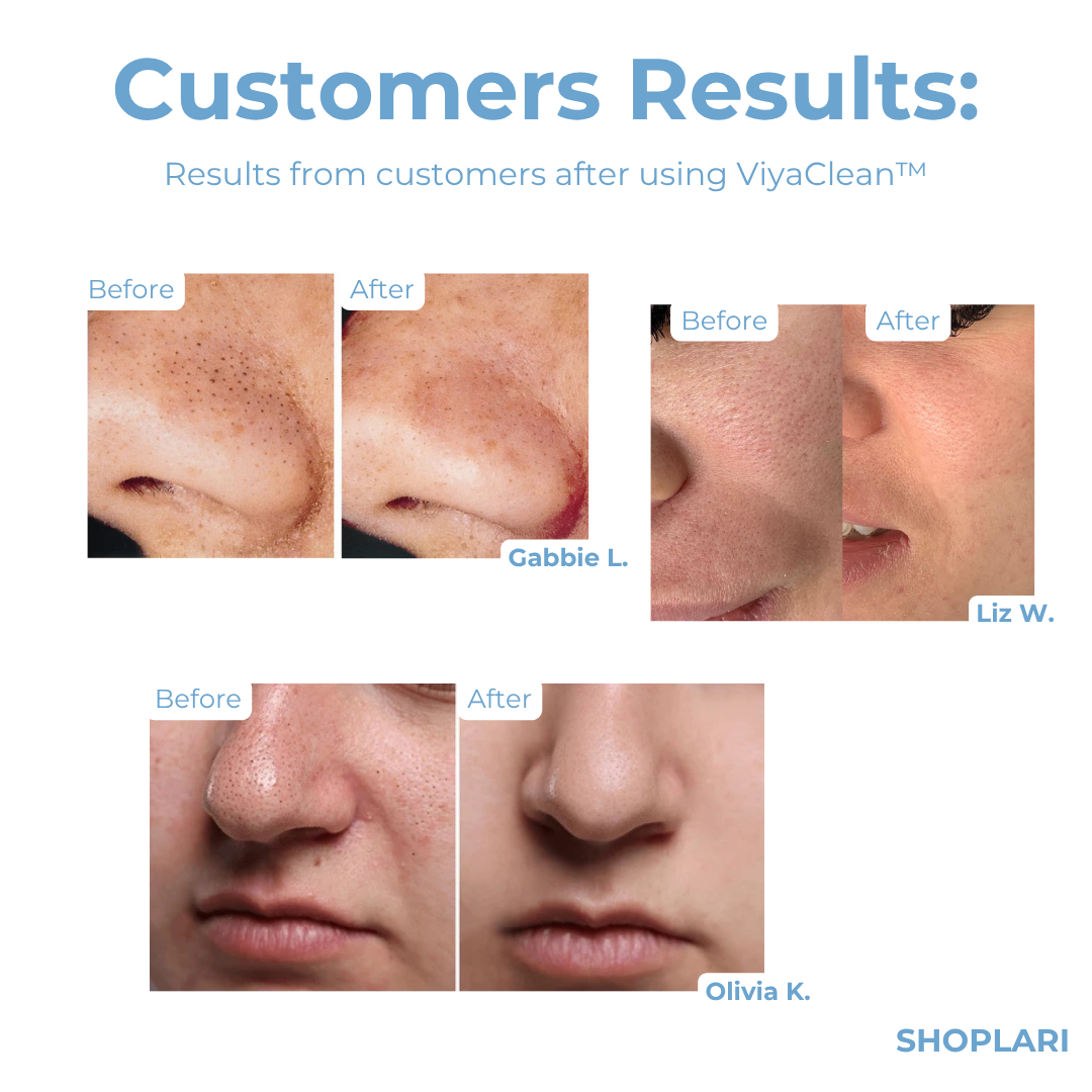 ViyaClean™ Porenreinigungsserum | Letzter Tag 5+5 GRATIS