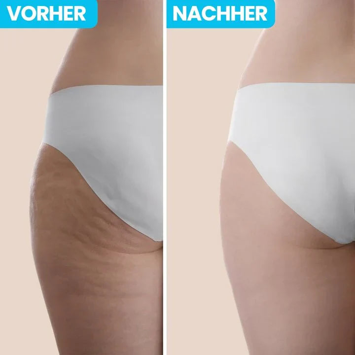 CelluPro Entfernen Sie bequem Cellulite von zu Hause aus!