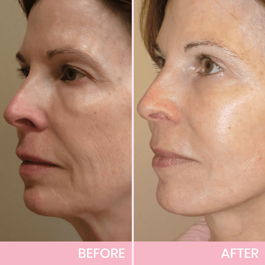 OUHOE| V-Face Lift Klebeband| Gesichtsstraffende unsichtbare Klebebänder (40 stucks)