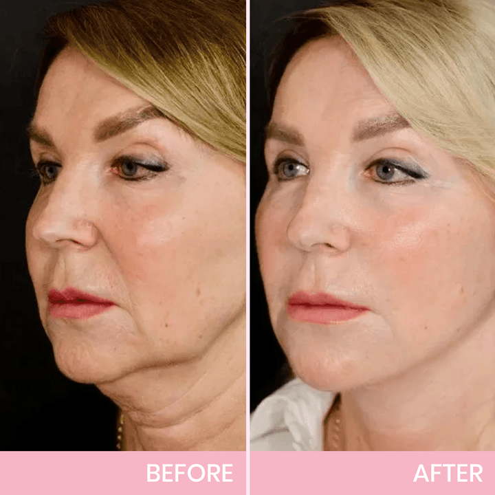OUHOE| V-Face Lift Klebeband| Gesichtsstraffende unsichtbare Klebebänder (40 stucks)