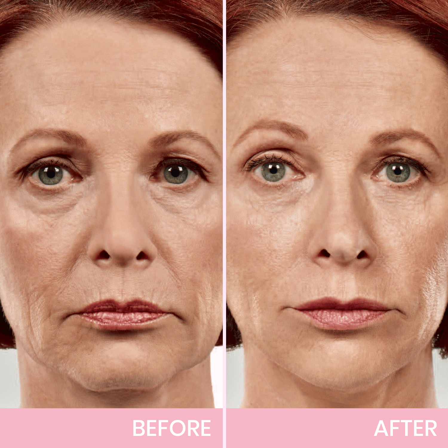 OUHOE™ | V-Face Lift Klebeband | Gesichtsstraffende unsichtbare Klebebänder (40 stucks)