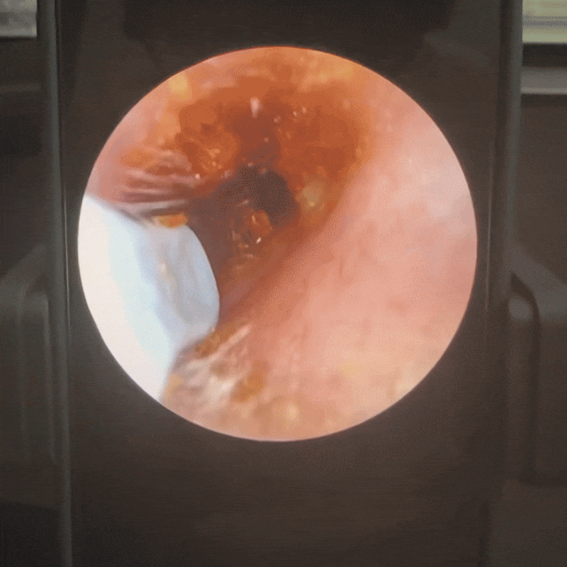 VisioEar Pro™ | Medizinisch geprüfte Endoskop-Ohrpflege mit HD-Kamera