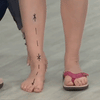 Pylera™ | Orthopädische Sommerschuhe