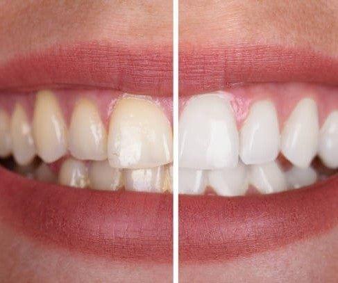 SmileKit™ | Fühlen Sie sich selbstbewusster mit einem frischen und strahlenden Lächeln, das lange anhält