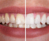 SmileKit™ | Fühlen Sie sich selbstbewusster mit einem frischen und strahlenden Lächeln, das lange anhält
