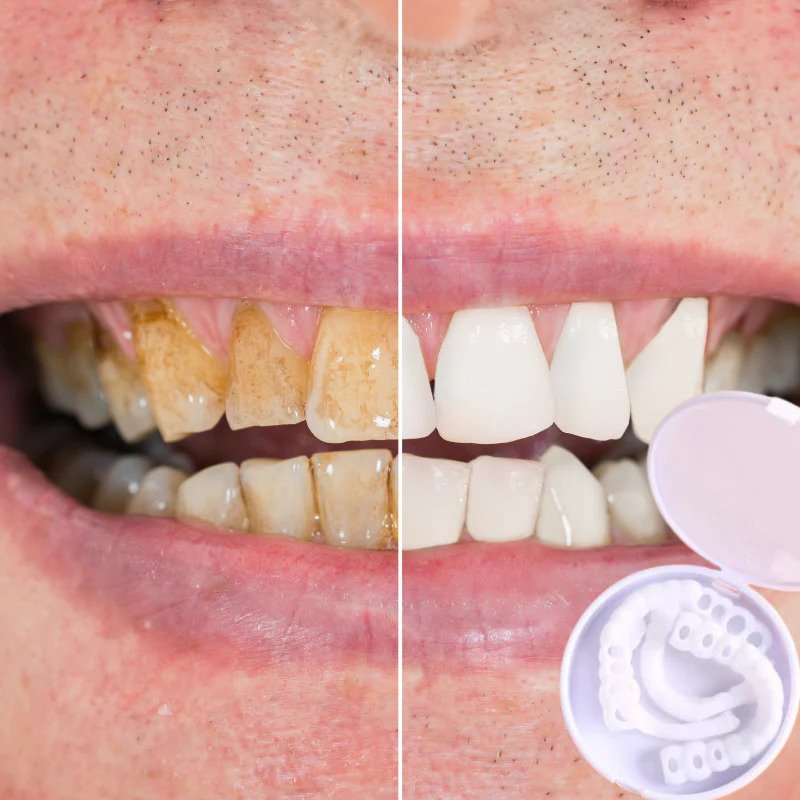 Snap-on Zähne - Mit diesen Veneers immer das perfekte Lächeln