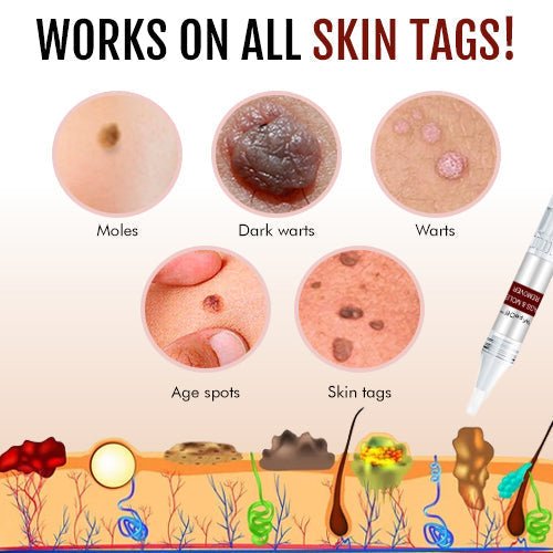 ClearMole™- Haut Tag &amp; Warze Entferner