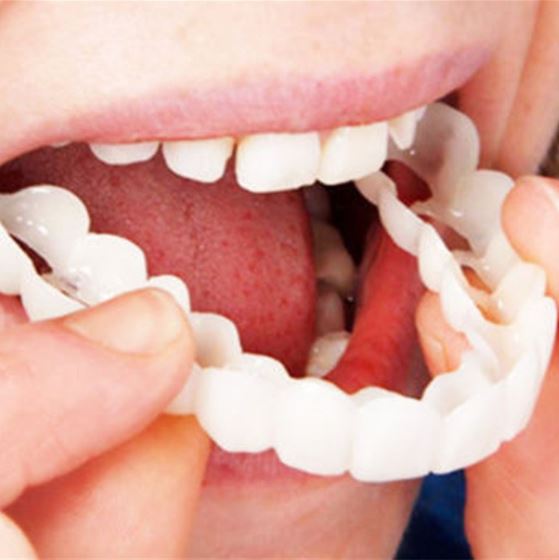 Snap-on Zähne - Mit diesen Veneers immer das perfekte Lächeln